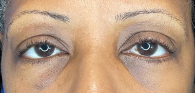Eyelid Lift (Blepharoplasty)