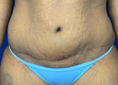 Tummy tuck