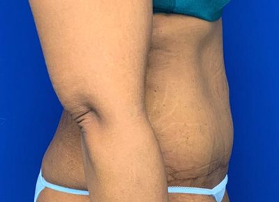 Tummy tuck