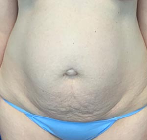 Tummy tuck