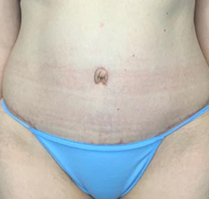 Tummy tuck