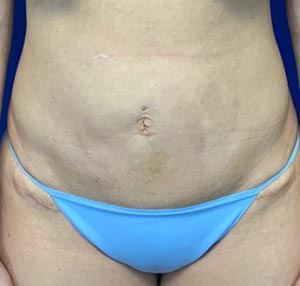 Tummy tuck