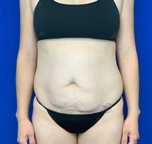 Tummy tuck