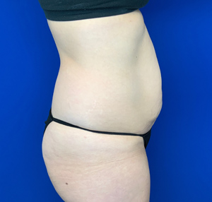 Tummy tuck