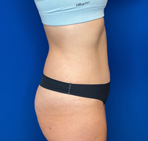 Tummy tuck