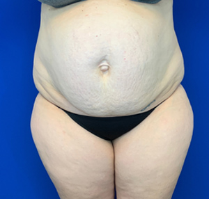 Tummy tuck