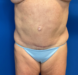 Tummy tuck