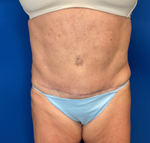 Tummy tuck