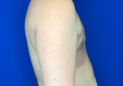 DIEP Flap Reconstruction