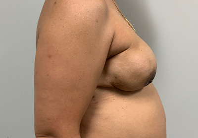 DIEP Flap Reconstruction