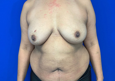 DIEP Flap Reconstruction