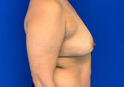 DIEP Flap Reconstruction