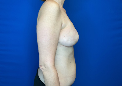 DIEP Flap Reconstruction