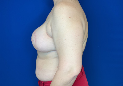 DIEP Flap Reconstruction