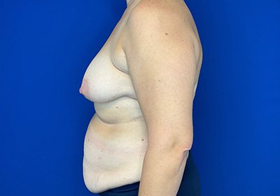 DIEP Flap Reconstruction