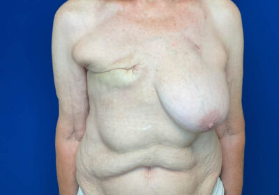 DIEP Flap Reconstruction