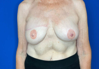 DIEP Flap Reconstruction