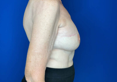 DIEP Flap Reconstruction