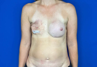 DIEP Flap Reconstruction