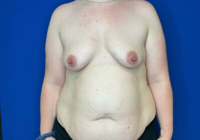 DIEP Flap Reconstruction