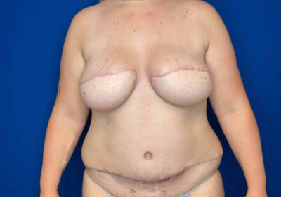 DIEP Flap Reconstruction