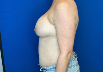 DIEP Flap Reconstruction