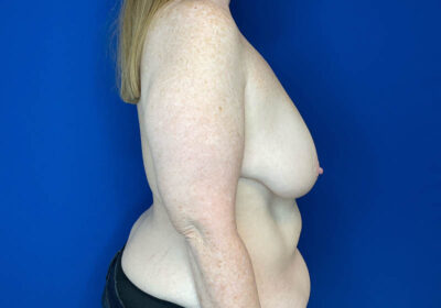 DIEP Flap Reconstruction