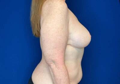 DIEP Flap Reconstruction