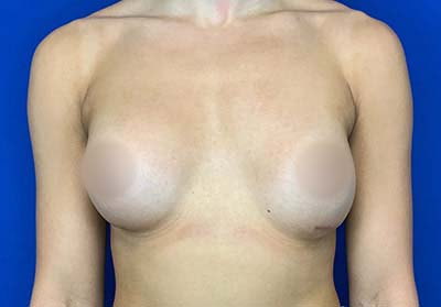 Real patient Breast Augmentation after photo
