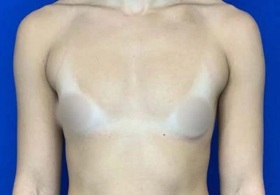 Real patient Breast Augmentation before photo